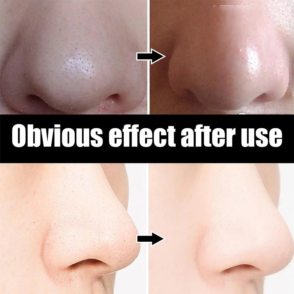 10pcs/Box Blackhead Remover Nose Strips Nasal Patch Deep Cleaning Shrink Pores Acne Treatment Nose Blackhead Mask Strip Skincare